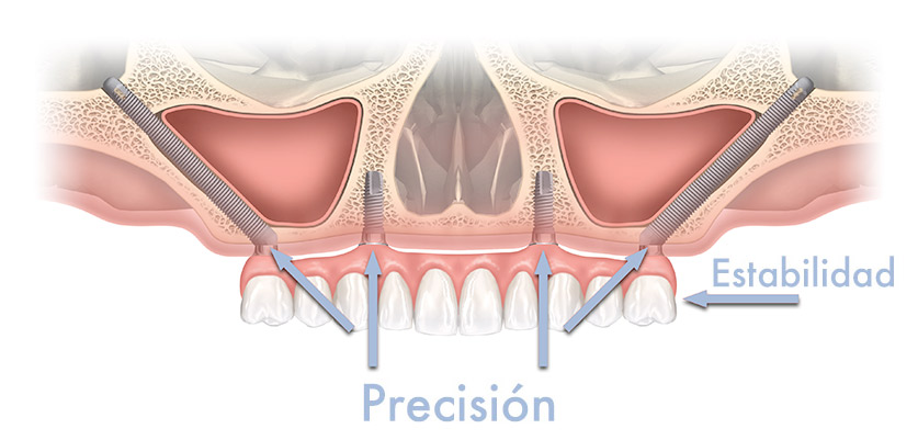 Implantes dentales cigomaticos