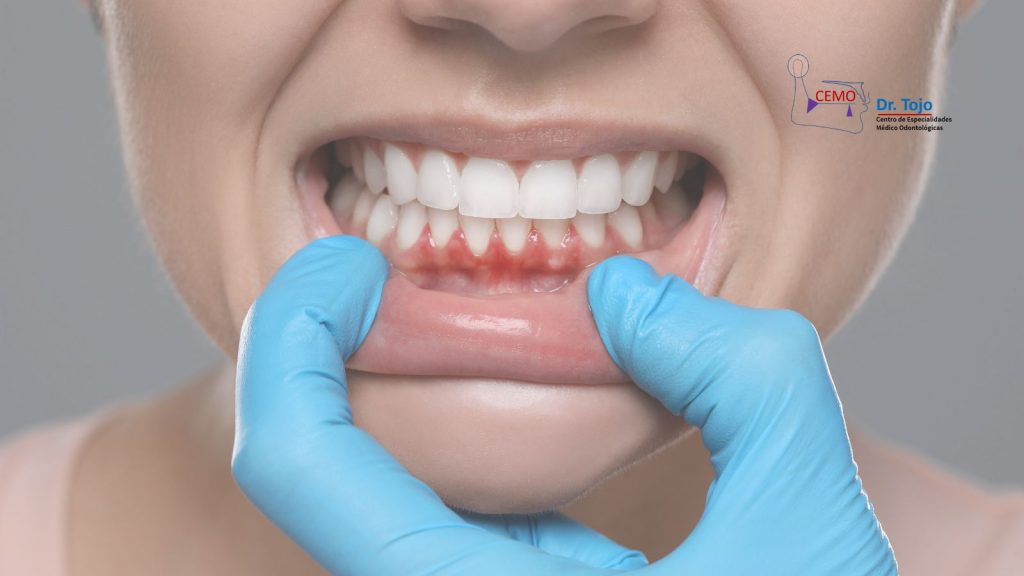 Injerto de encía: ¿en qué consiste, cómo se realiza y qué complicaciones puede tener?