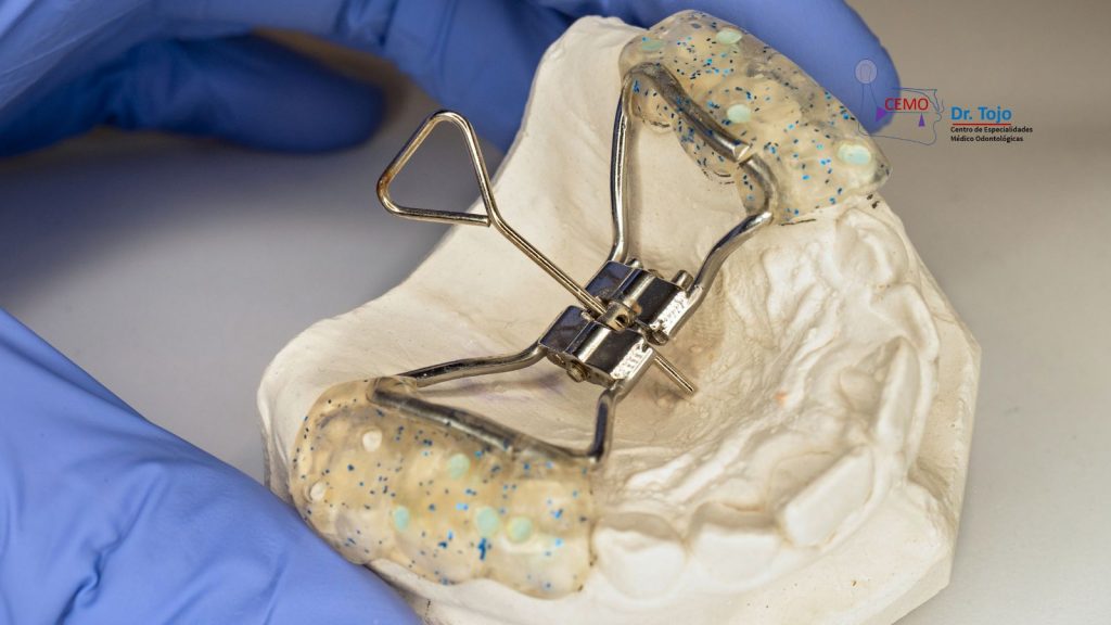 Ortodoncia infantil: el expansor palatino