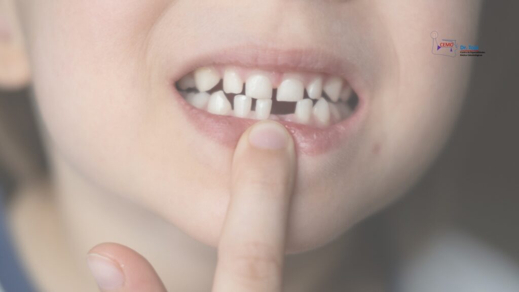 ¿Caries en los dientes de leche?